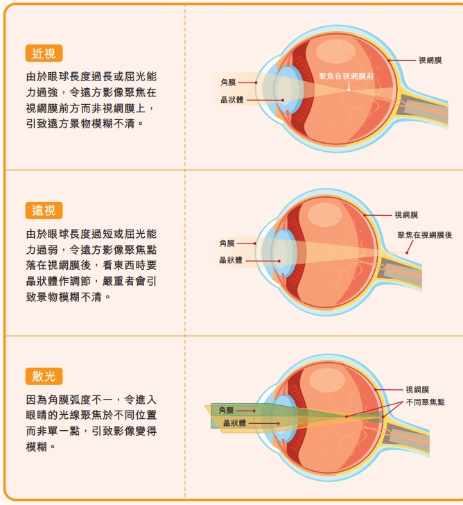 近視、遠視與散光定義