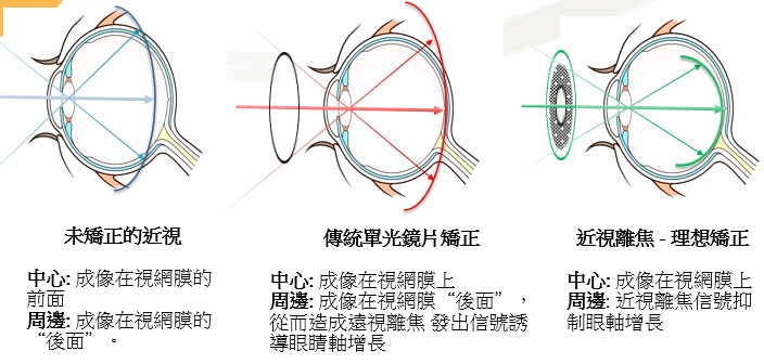 近視離焦的原理